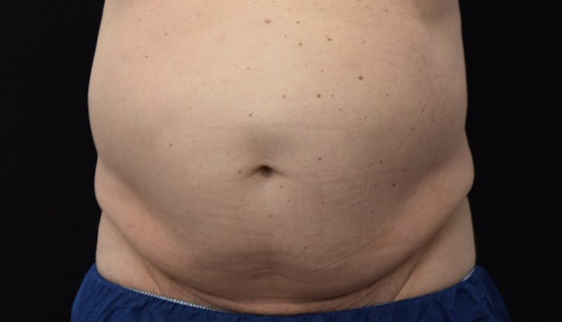 Abdominoplasty Before & After Gallery - Patient 102433844 - Image 1