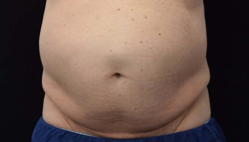 Abdominoplasty Before & After Gallery - Patient 102433844 - Image 1