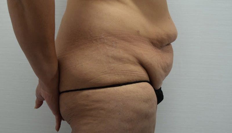 Massive Weight Loss Before & After Gallery - Patient 102433792 - Image 5