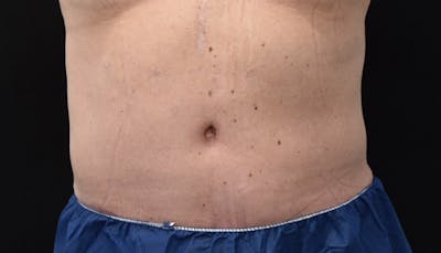 Abdominoplasty Before & After Gallery - Patient 102433844 - Image 2