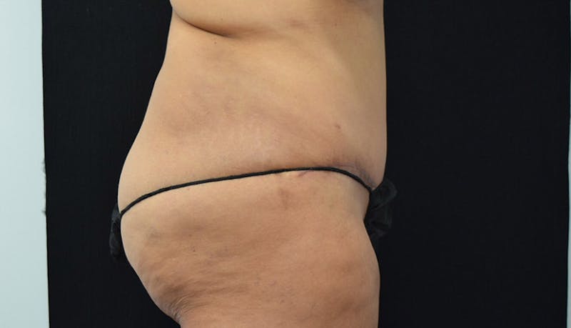 Massive Weight Loss Gallery - Patient 102433792 - Image 6