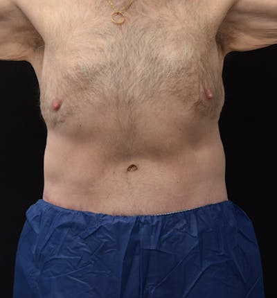 Male Lower Body Lift Before & After Gallery - Patient 148037526 - Image 2