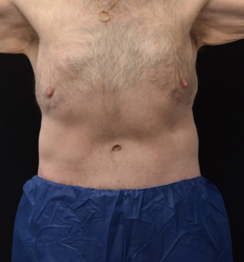 Male Lower Body Lift Before & After Gallery - Patient 148037526 - Image 2
