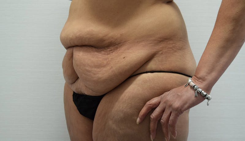 Massive Weight Loss Gallery - Patient 102433792 - Image 7