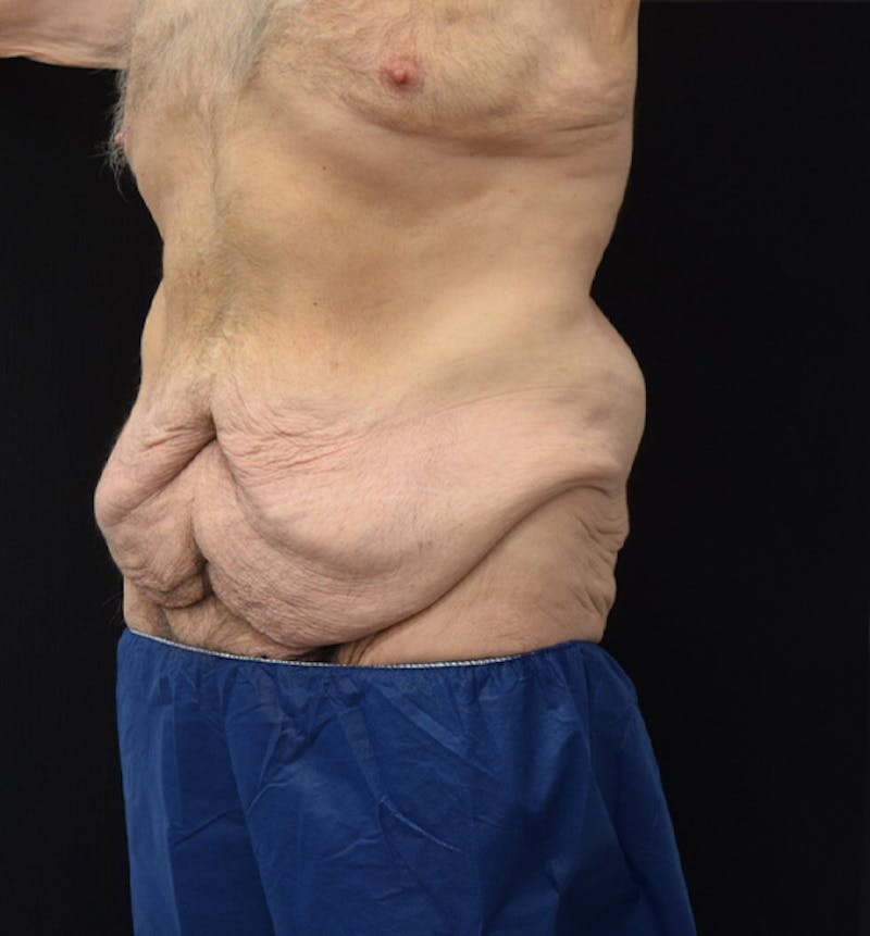 Male Lower Body Lift Before & After Gallery - Patient 148037526 - Image 3