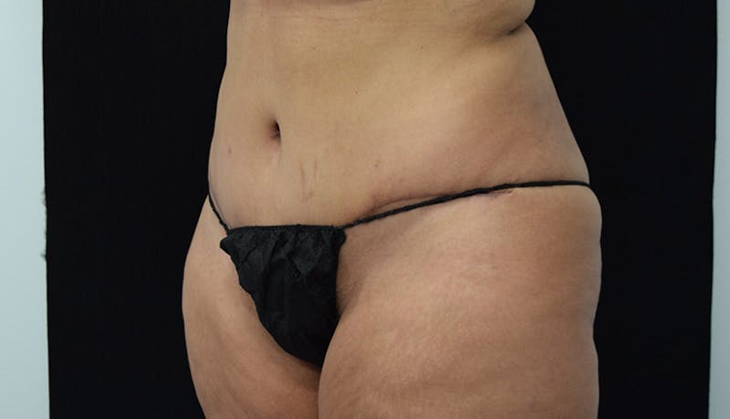 Massive Weight Loss Gallery - Patient 102433792 - Image 8