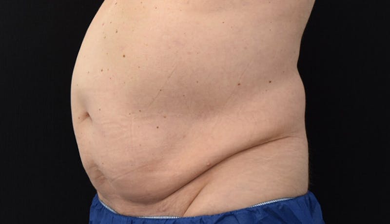 Abdominoplasty Before & After Gallery - Patient 102433844 - Image 3