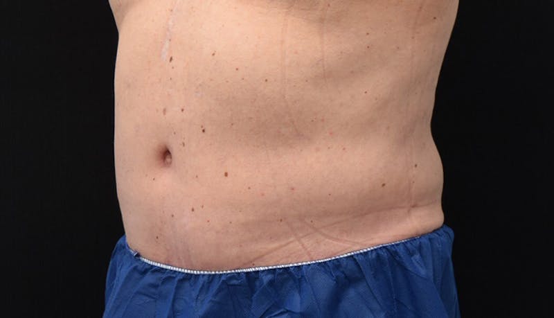 Abdominoplasty Before & After Gallery - Patient 102433844 - Image 4