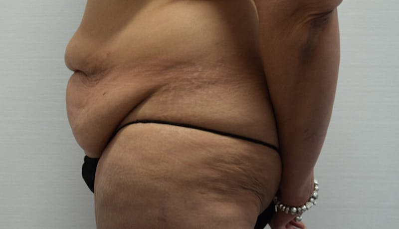 Massive Weight Loss Before & After Gallery - Patient 102433792 - Image 9