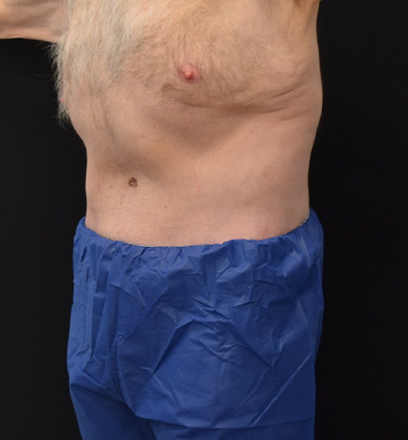 Male Lower Body Lift Before & After Gallery - Patient 148037526 - Image 4