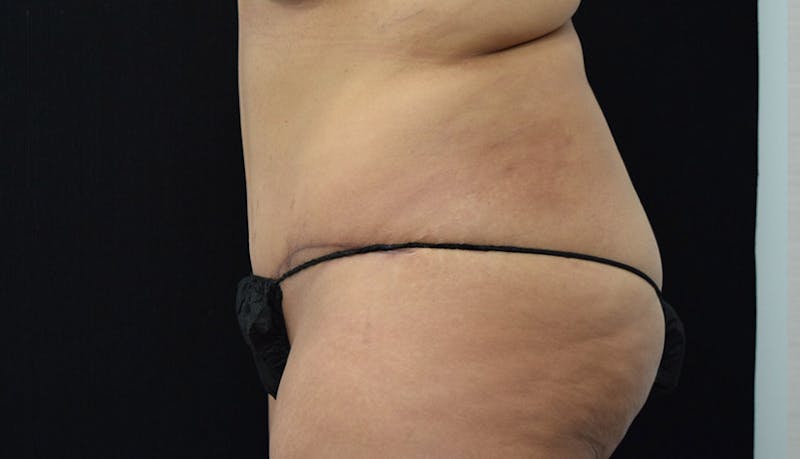 Massive Weight Loss Gallery - Patient 102433792 - Image 10