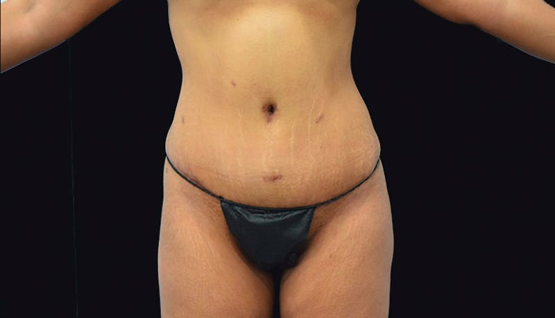 Massive Weight Loss Gallery - Patient 102433848 - Image 2