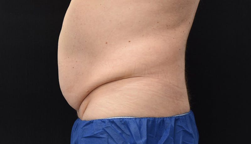 Abdominoplasty Before & After Gallery - Patient 102433844 - Image 5
