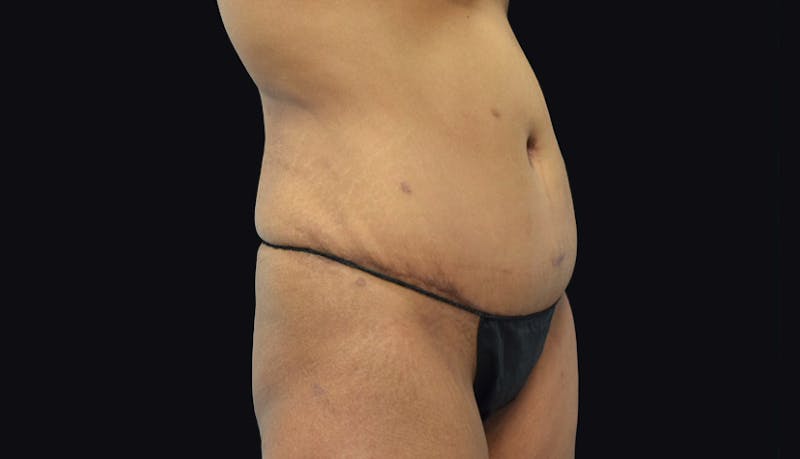 Massive Weight Loss Gallery - Patient 102433848 - Image 4