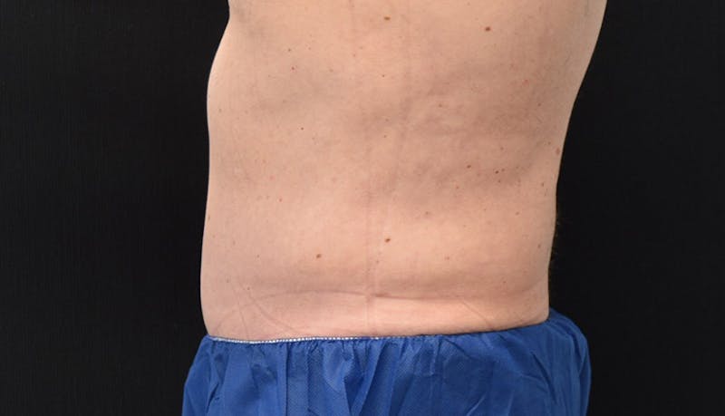 Abdominoplasty Before & After Gallery - Patient 102433844 - Image 6
