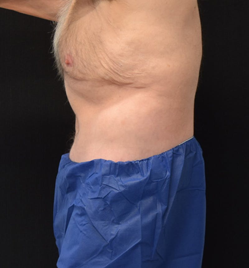Male Lower Body Lift Before & After Gallery - Patient 148037526 - Image 6