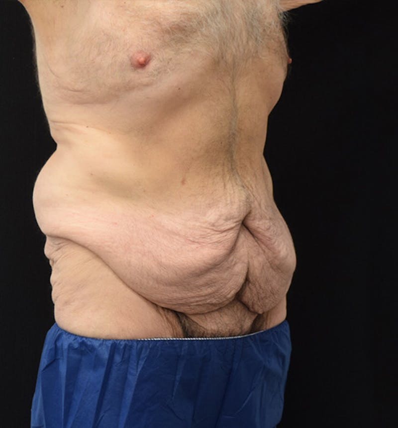 Male Lower Body Lift Before & After Gallery - Patient 148037526 - Image 7