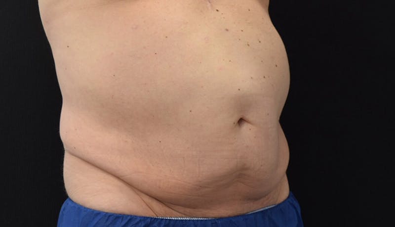 Abdominoplasty Before & After Gallery - Patient 102433844 - Image 7