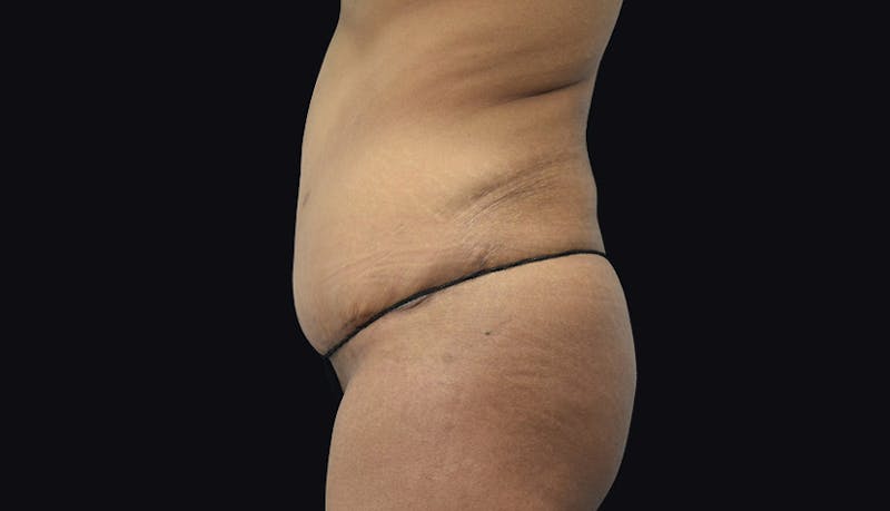 Massive Weight Loss Before & After Gallery - Patient 102433848 - Image 6