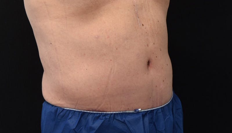 Abdominoplasty Before & After Gallery - Patient 102433844 - Image 8