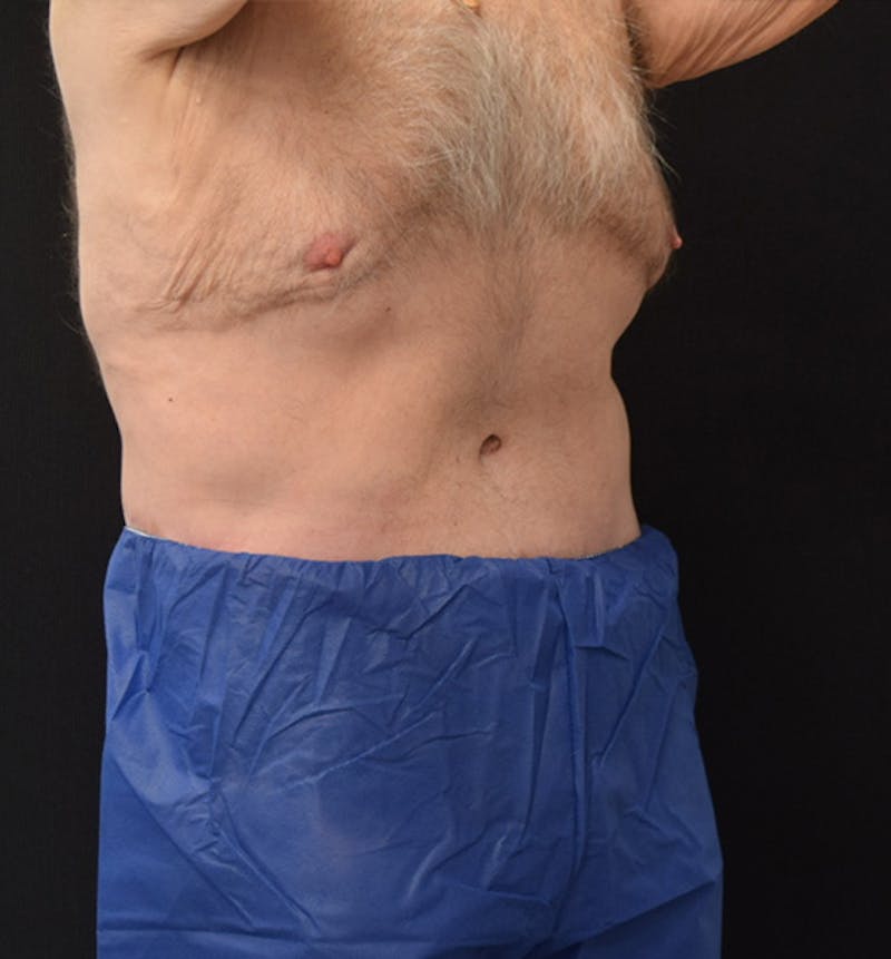 Male Lower Body Lift Before & After Gallery - Patient 148037526 - Image 8