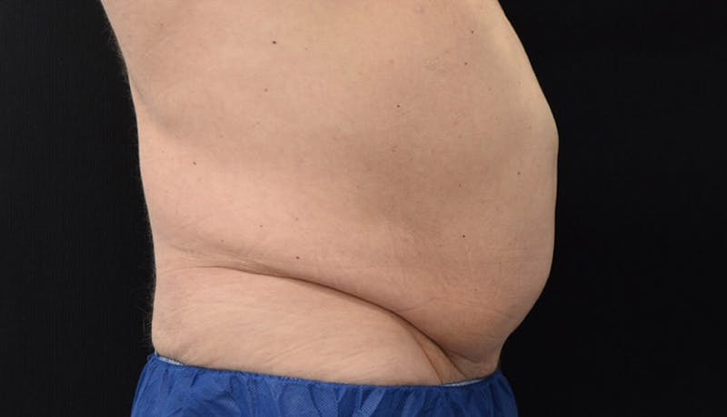 Abdominoplasty Before & After Gallery - Patient 102433844 - Image 9