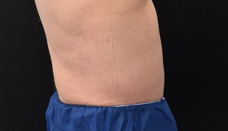 Abdominoplasty Before & After Gallery - Patient 102433844 - Image 10