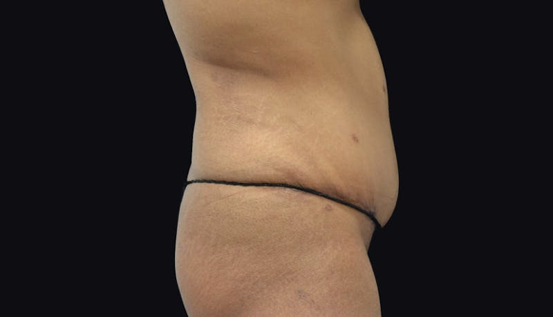 Massive Weight Loss Before & After Gallery - Patient 102433848 - Image 8