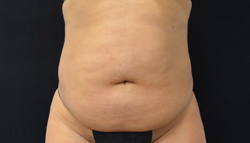Abdominoplasty Before & After Gallery - Patient 102441588 - Image 1