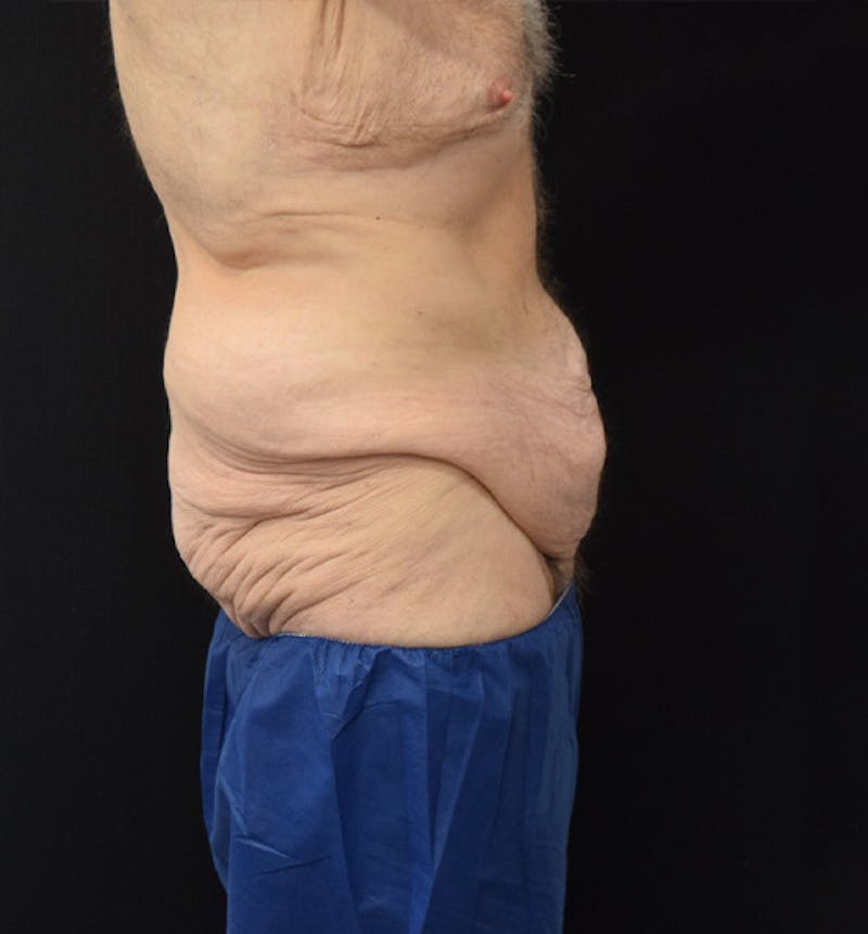 Male Lower Body Lift Before & After Gallery - Patient 148037526 - Image 9