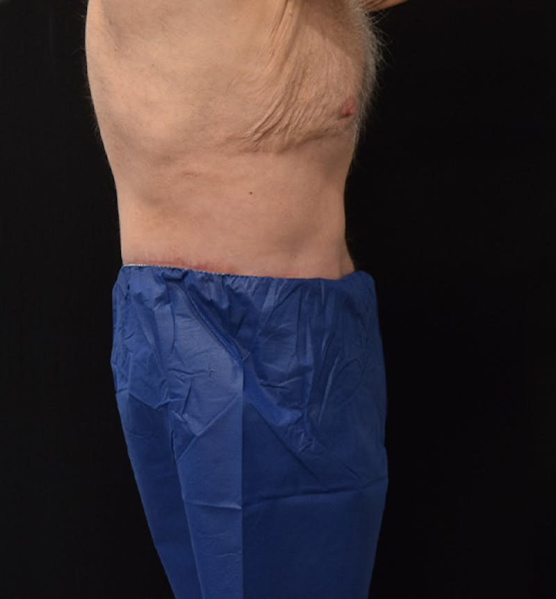 Male Lower Body Lift Before & After Gallery - Patient 148037526 - Image 10