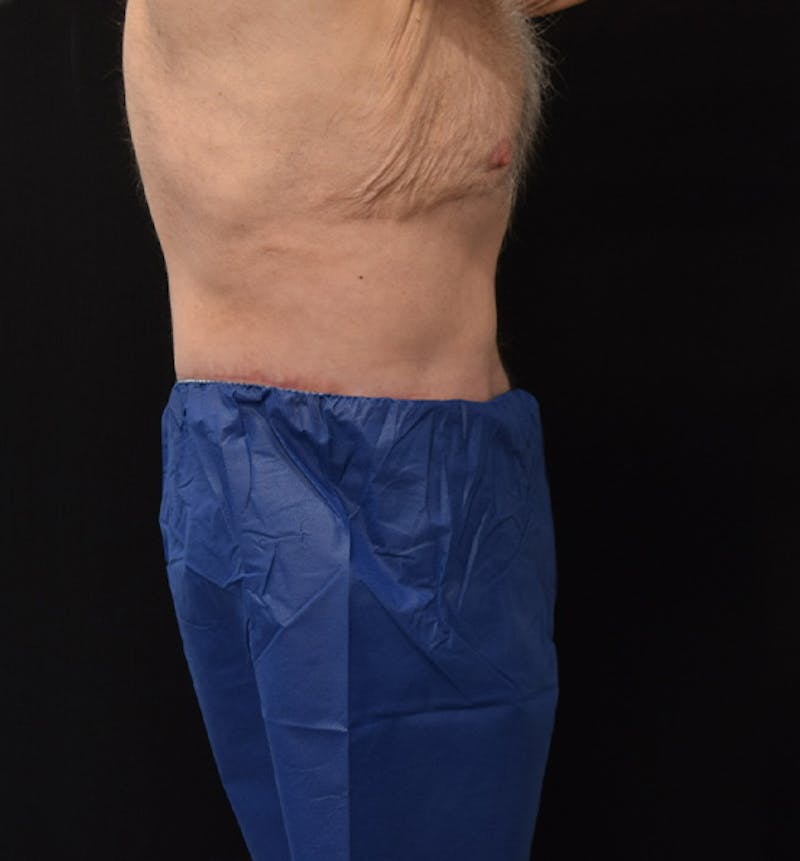 Lower Body Lift Before & After Gallery - Patient 148037526 - Image 10