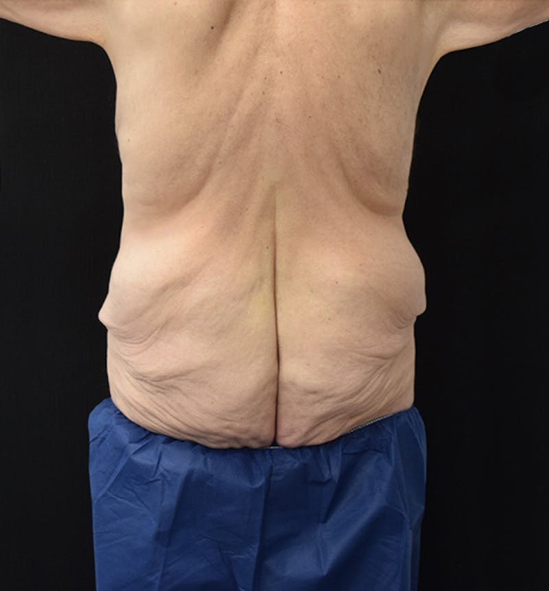 Lower Body Lift Before & After Patient 78, NYC