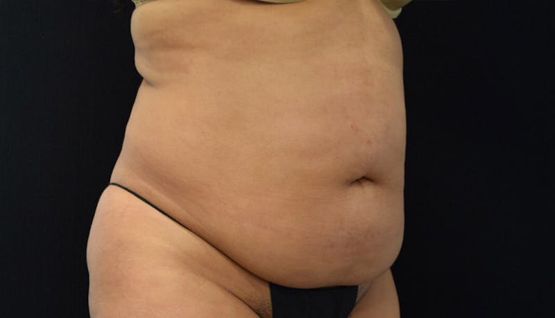 Abdominoplasty Before & After Gallery - Patient 102441588 - Image 3