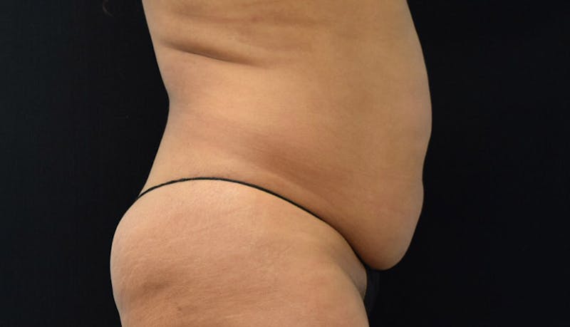 Abdominoplasty Before & After Gallery - Patient 102441588 - Image 5
