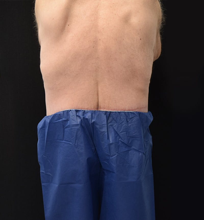 Male Lower Body Lift Before & After Gallery - Patient 148037526 - Image 12