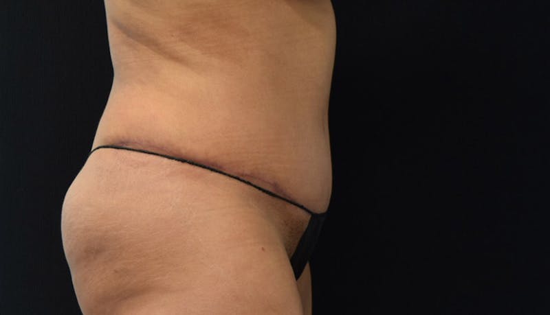 Abdominoplasty Before & After Gallery - Patient 102441588 - Image 6