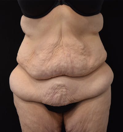 Lower Body Lift Before & After Gallery - Patient 102449303 - Image 1