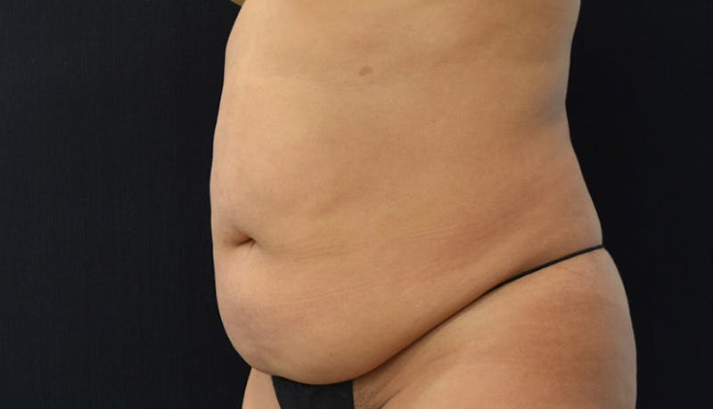 Abdominoplasty Before & After Gallery - Patient 102441588 - Image 7