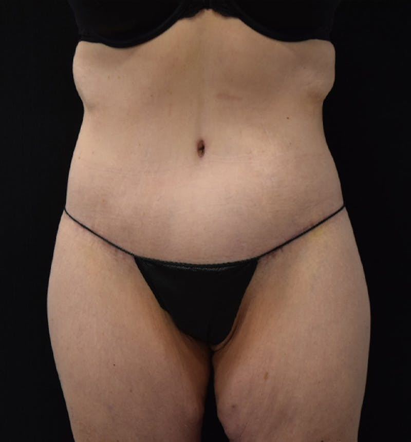 Lower Body Lift Before & After Gallery - Patient 102449303 - Image 2