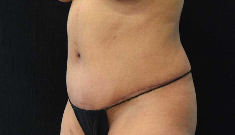 Abdominoplasty Before & After Gallery - Patient 102441588 - Image 8