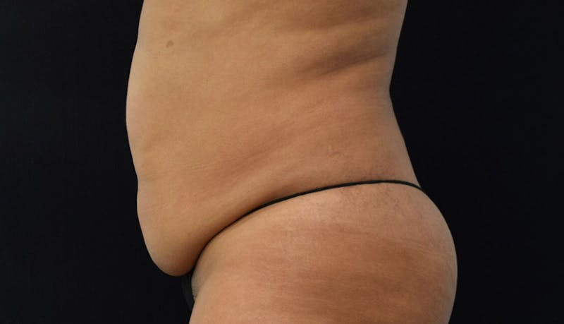 Abdominoplasty Before & After Gallery - Patient 102441588 - Image 9