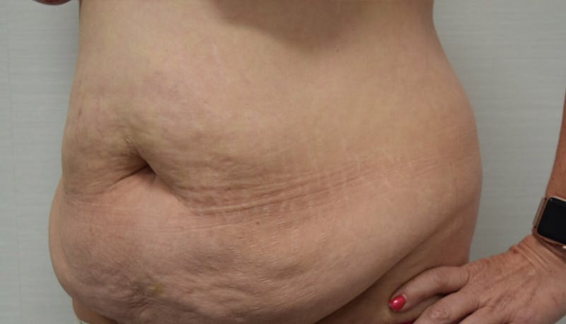 Massive Weight Loss Before & After Gallery - Patient 102441583 - Image 9