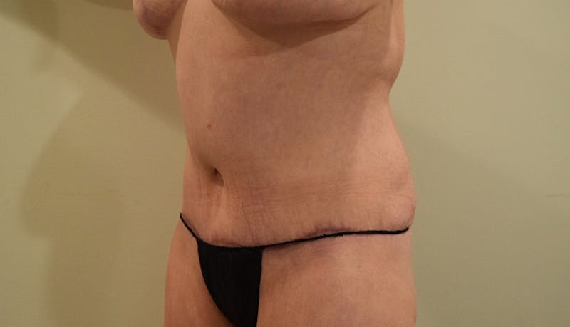 Massive Weight Loss Before & After Gallery - Patient 102441583 - Image 10