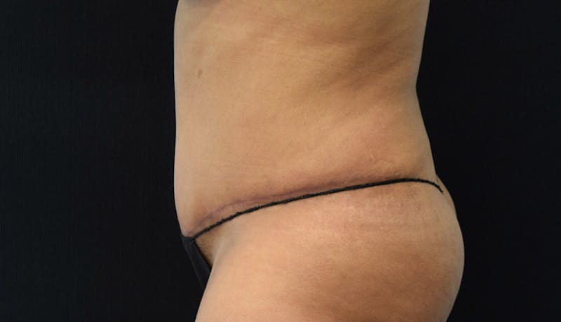 Abdominoplasty Before & After Gallery - Patient 102441588 - Image 10