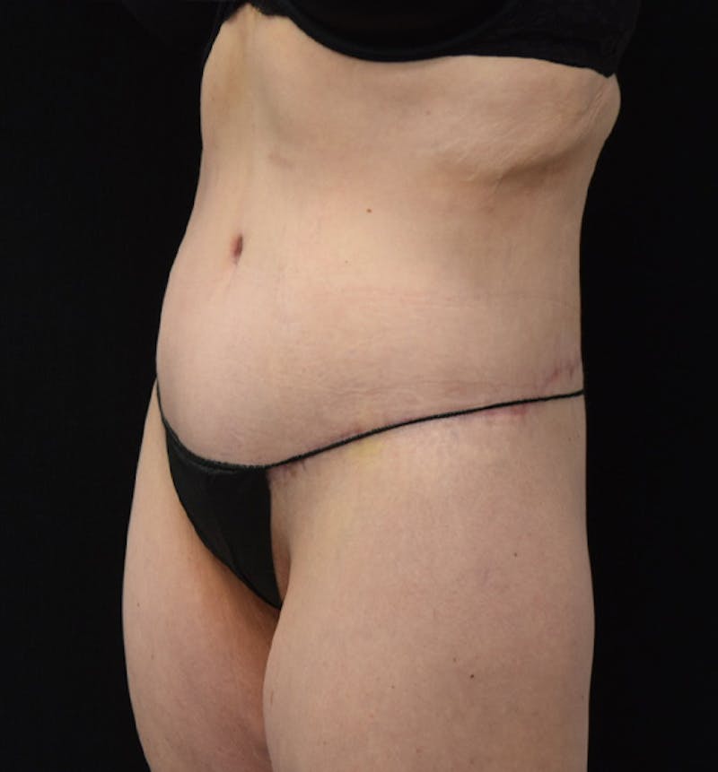 Lower Body Lift Before & After Gallery - Patient 102449303 - Image 4
