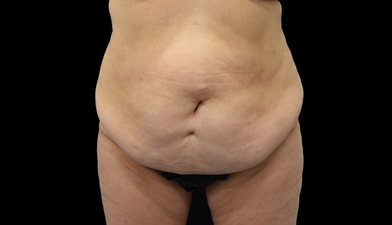 Massive Weight Loss Gallery - Patient 102449301 - Image 1