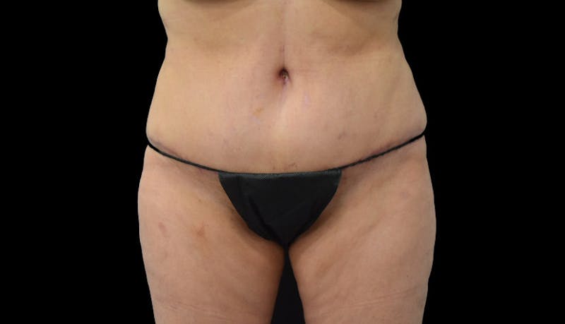 Massive Weight Loss Before & After Gallery - Patient 102449301 - Image 2