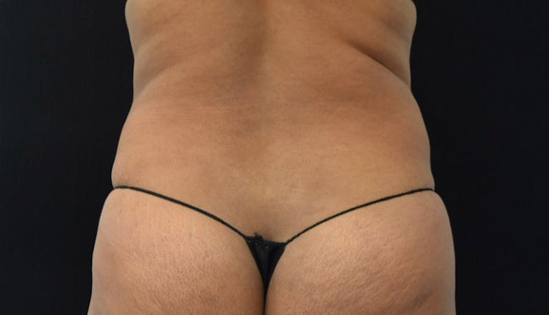Abdominoplasty Before & After Gallery - Patient 102441588 - Image 11