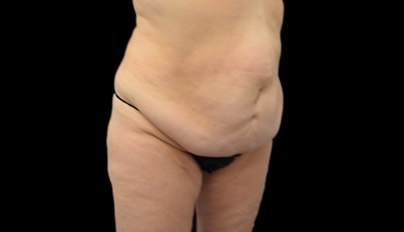 Massive Weight Loss Before & After Gallery - Patient 102449301 - Image 3